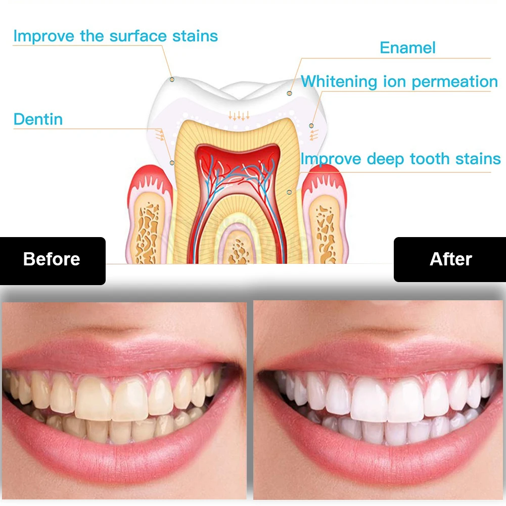 歯科歯ホワイトニングキットミニ 16 LED コールドライト - Teeth Whitening Gel Peroxide のレビューと価格